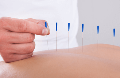 Acupuncture Therapy